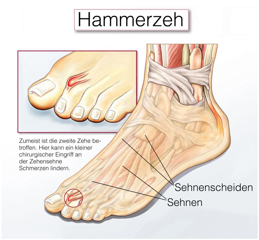 Hammerzehe