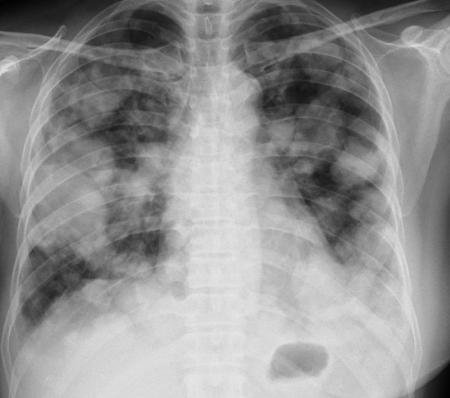 Lungenmetastasen im Röntgenbild