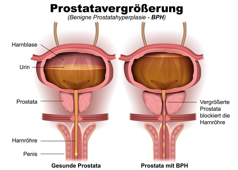 Prostata von außen