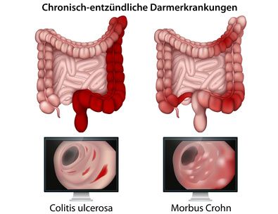 Colitis ulcerosa und Morbus Crohn