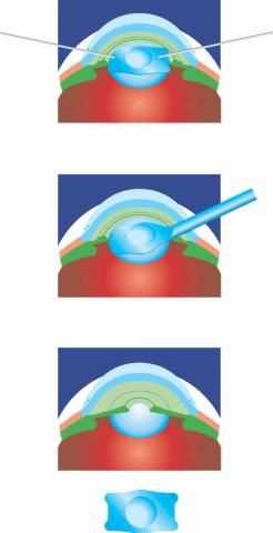 Implantierbare Kontaktlinse Vorgehen
