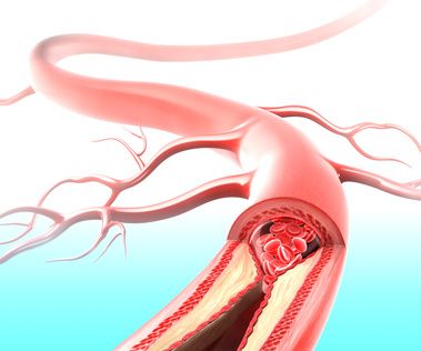 Arteriosklerose Gefäßverschluss