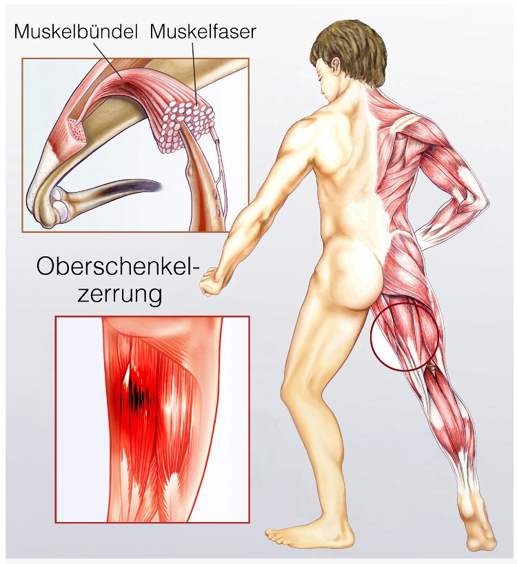 Muskelzerrung Oberschenkel