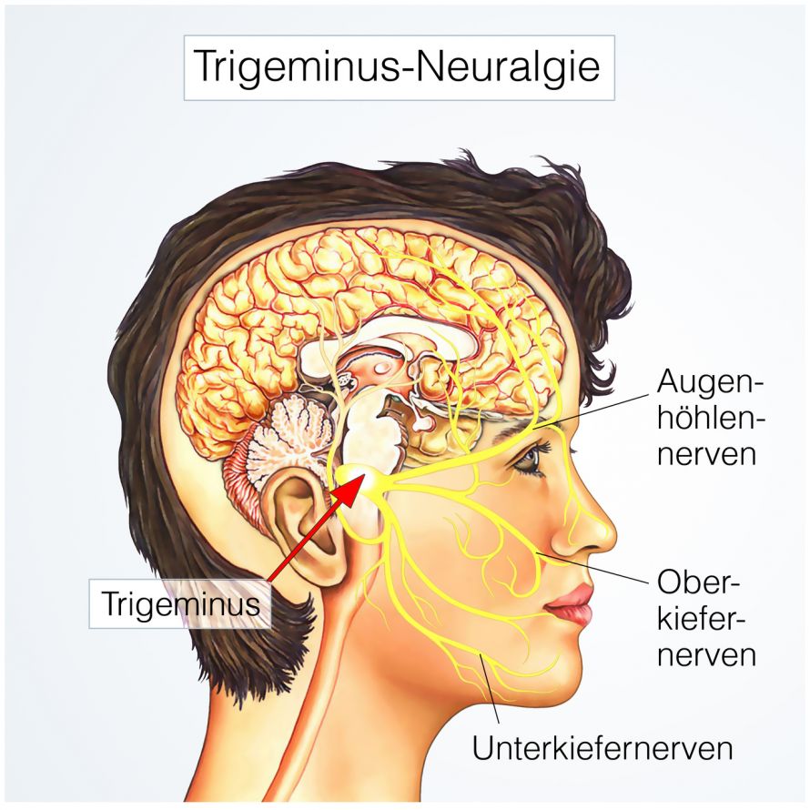 Trigeminusnerv gereizt symptome