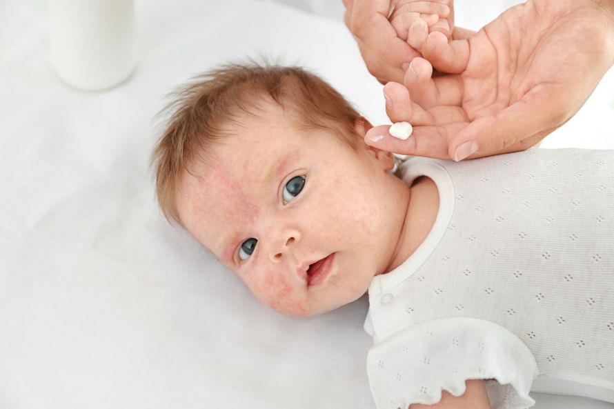 Baby mit Neurodermitis