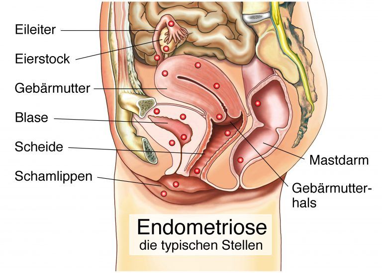 Menstruationsschmerzen Wie Messerstiche Endometriose Prof Wallwiener Im Int...