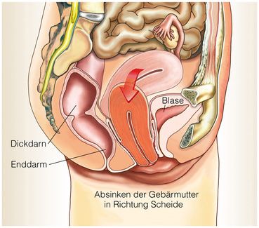 Stellung gebärmutter gekippt nach hinten welche ⚡ Retrovertierter