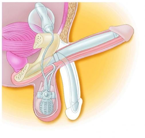 Implantat penis Penis Size