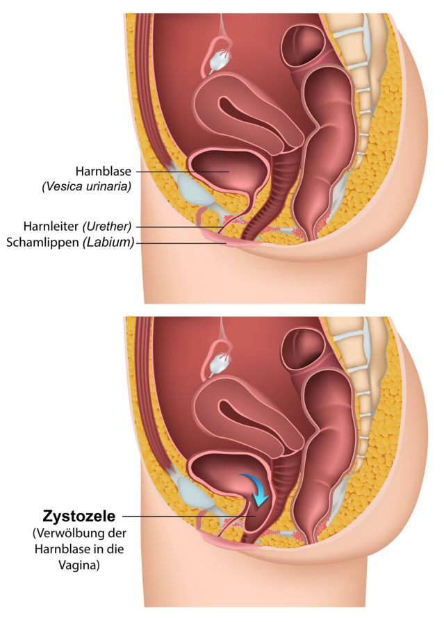 Op schmerzen gebärmutter danach Endometriumablation: Definition,