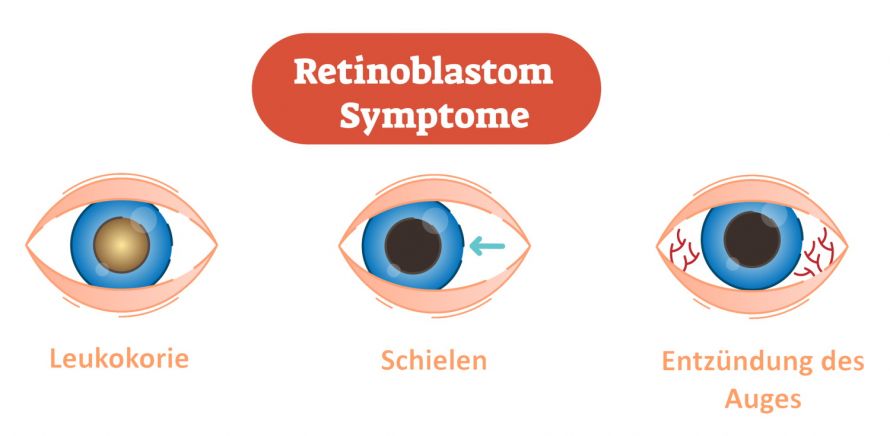 Retinoblastom Symptome