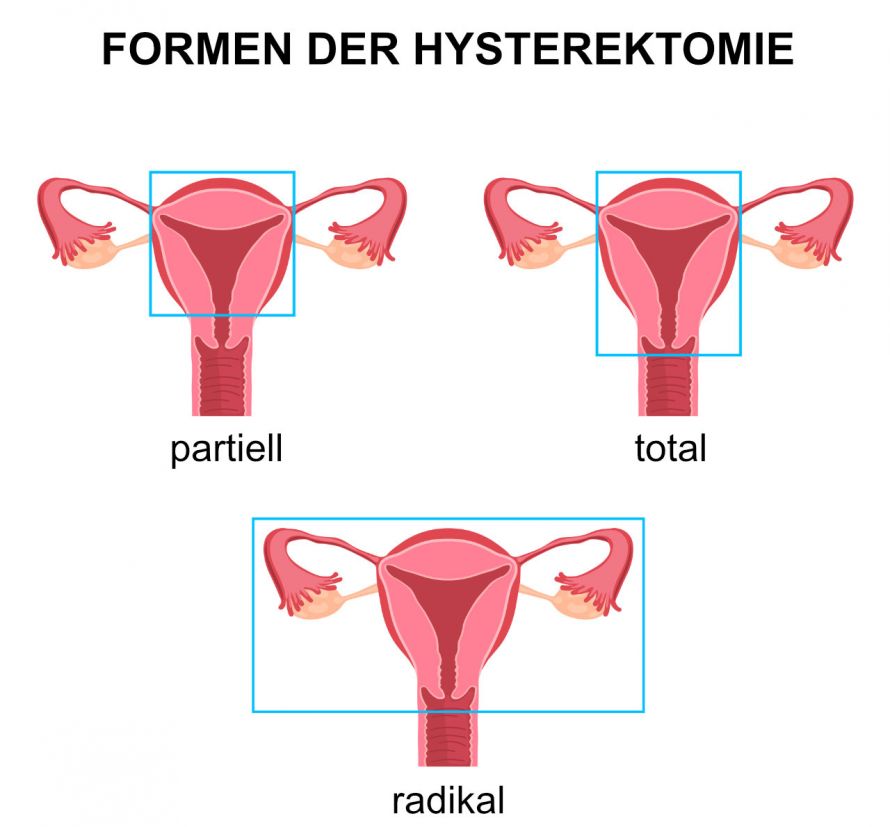 Formen der Hysterektomie