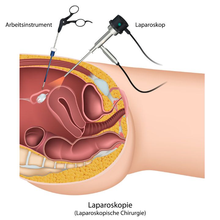 Laparoskopie bei einer Frau