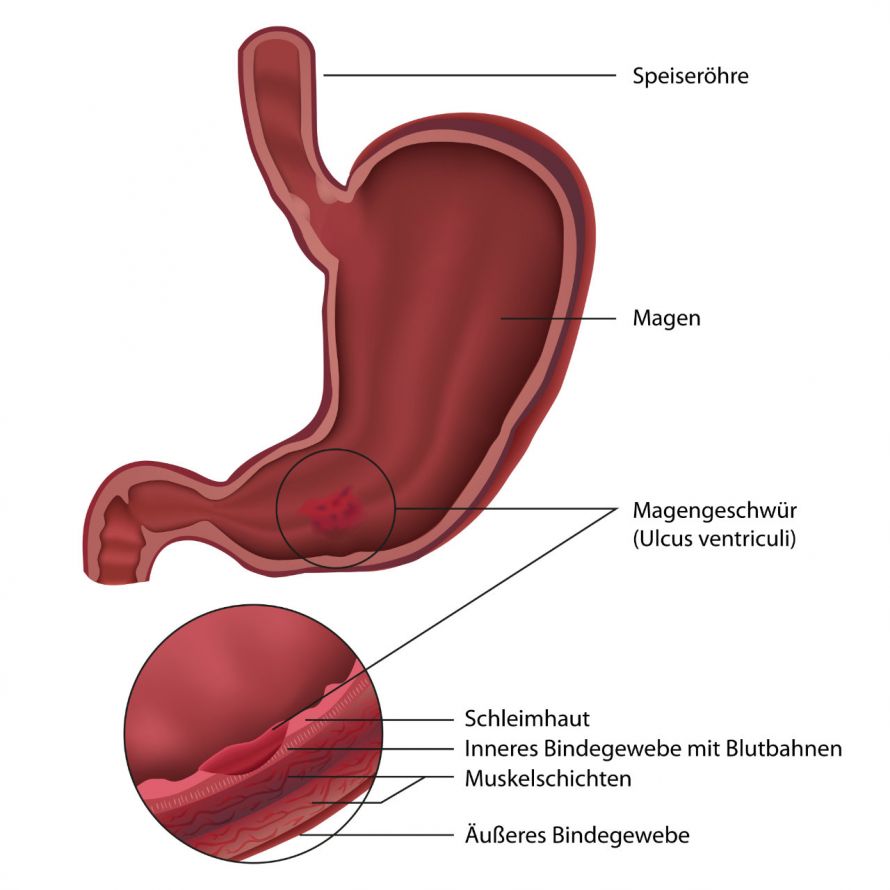 Querschnitt des Magens und Darstellung eines Magengeschwürs
