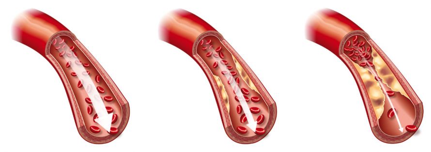 Darstellung von Arteriosklerose