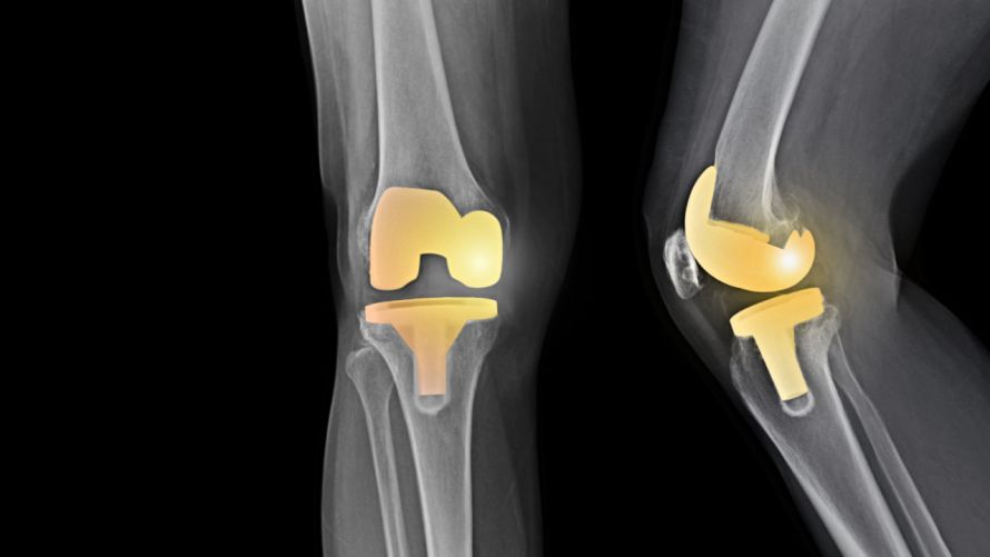 Eingesetzte Knieendoprothese