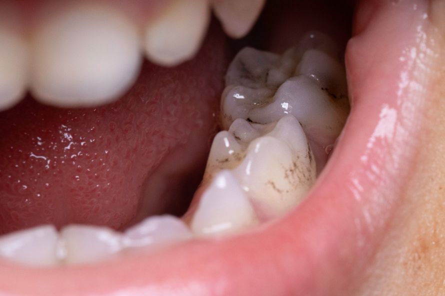 Karies an den Zähnen