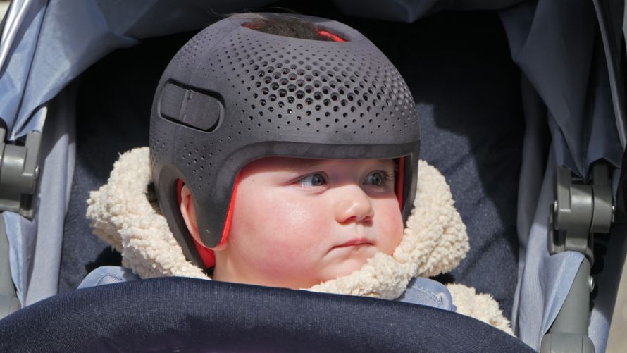 Kind mit Kraniosynostose, das einen speziellen Helm trägt