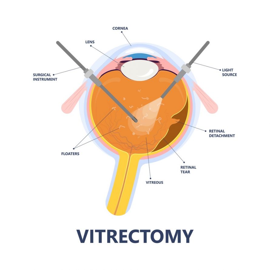 Darstellung einer Vitrektomie