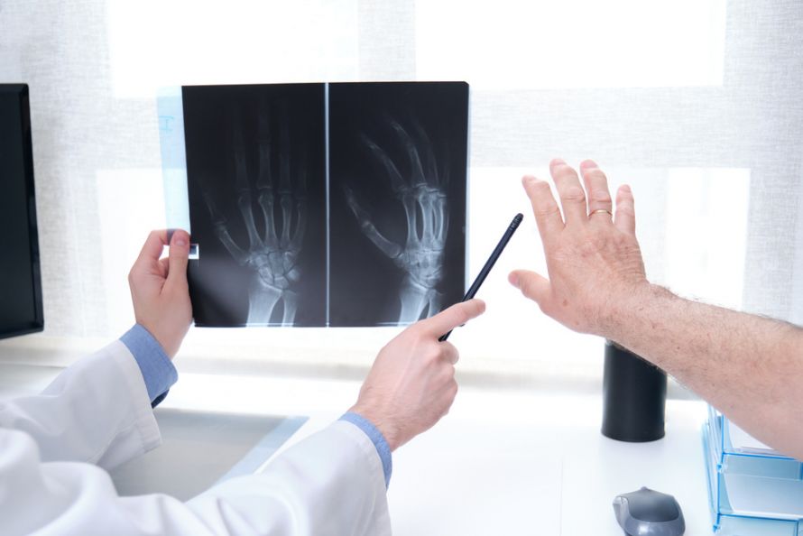 Röntgenbild bei Fingergelenksarthrose