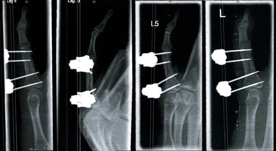 Röntgenaufnahme gebrochener kleinen Finger der linken Hand nach einem komplizierten Bruch