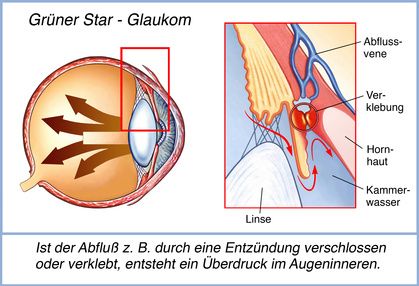 Grüner Star/Glaukom